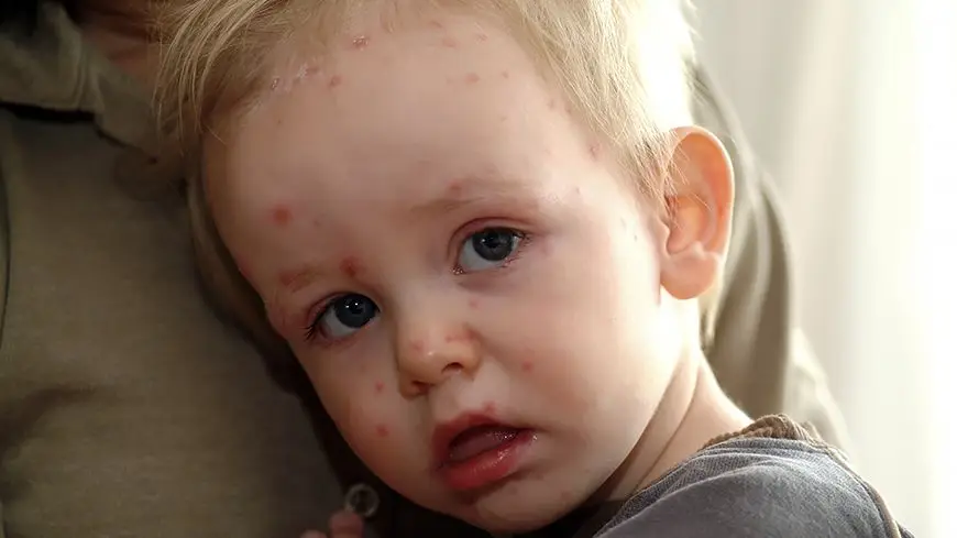 measles baby
